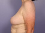 Breast Reduction (for Women) Before and after photo