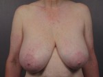 Breast Reduction (for Women)