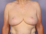 Breast Reduction (for Women) Before and after photo