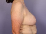 Breast Reduction (for Women) Before and after photo