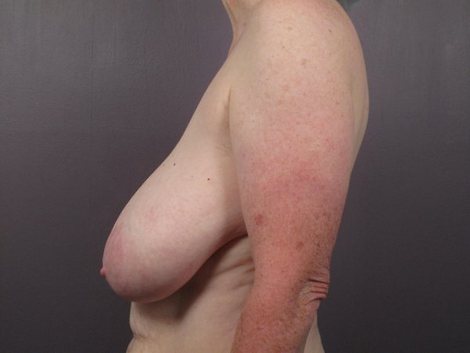 Breast Reduction (for Women) before and after photo