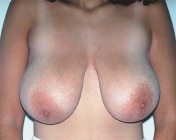 Breast Reduction (for Women) before and after photo