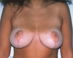 Breast Reduction (for Women) Before and after photo