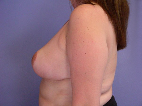 Breast Reduction (for Women) before and after photo