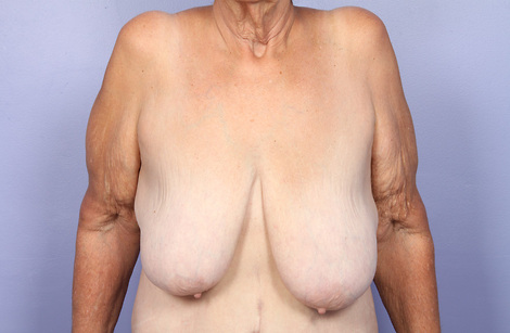 Breast Reduction (for Women) before and after photo