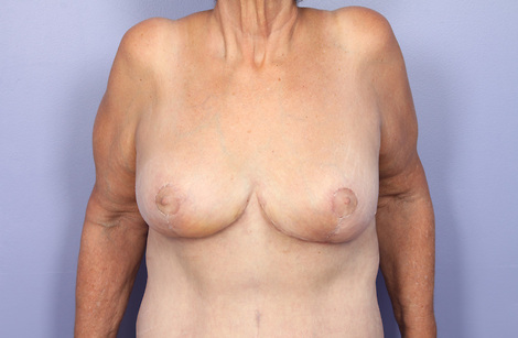 Breast Reduction (for Women) before and after photo