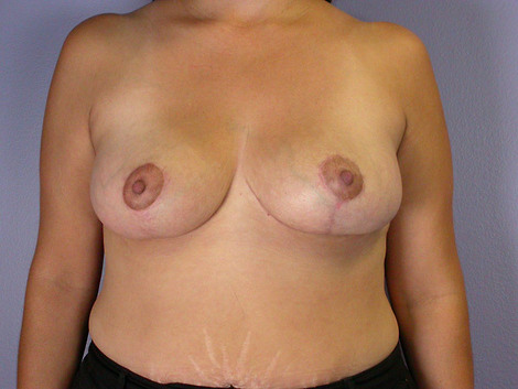 Breast Reduction (for Women) before and after photo