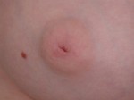 Nipple - Inversion Correction Before and after photo