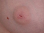 Nipple - Inversion Correction Before and after photo