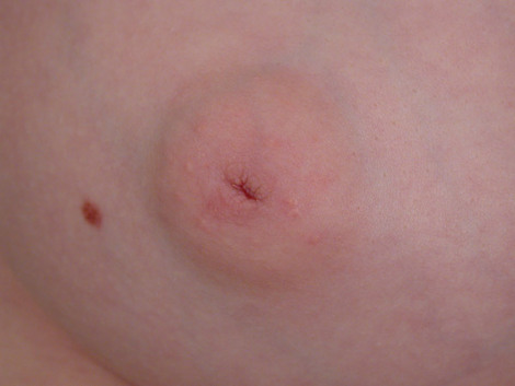 Nipple - Inversion Correction before and after photo