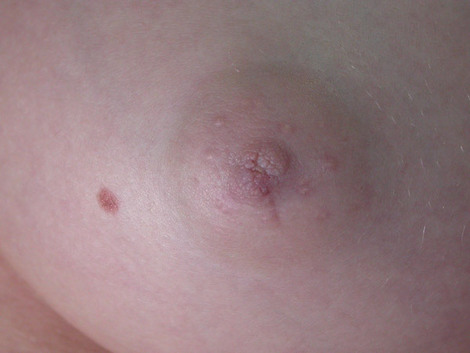 Nipple - Inversion Correction before and after photo