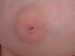 Nipple - Inversion Correction Before and after photo