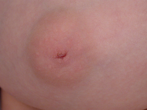 Nipple - Inversion Correction before and after photo