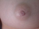 Nipple - Inversion Correction Before and after photo