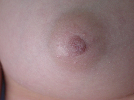 Nipple - Inversion Correction before and after photo