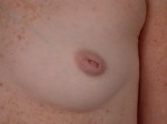 Nipple - Inversion Correction Before and after photo