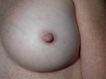 Nipple - Inversion Correction Before and after photo