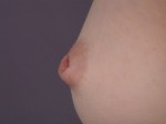 Nipple - Inversion Correction Before and after photo