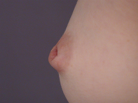 Nipple - Inversion Correction before and after photo