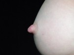Nipple - Inversion Correction Before and after photo