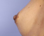 Nipple - Inversion Correction Before and after photo