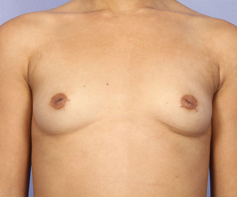 Nipple - Inversion Correction before and after photo