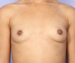 Nipple - Inversion Correction Before and after photo