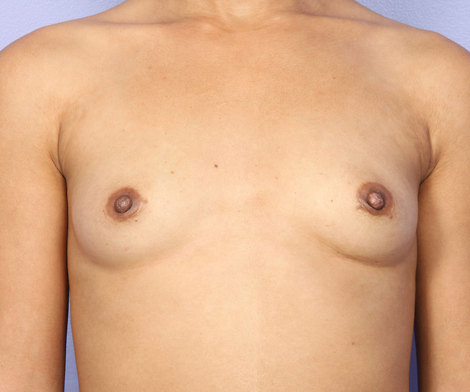 Nipple - Inversion Correction before and after photo