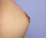 Nipple - Inversion Correction Before and after photo