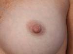 Nipple - Inversion Correction Before and after photo