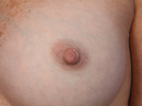 Nipple - Inversion Correction before and after photo