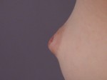 Nipple - Inversion Correction Before and after photo