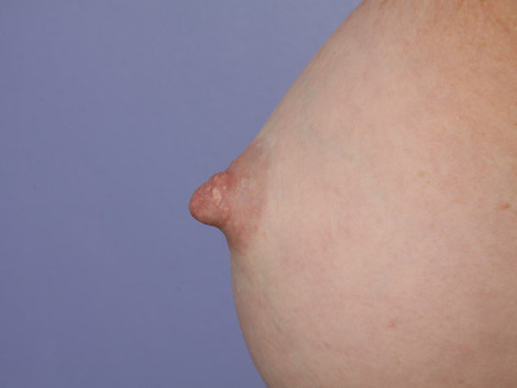 Nipple - Inversion Correction before and after photo