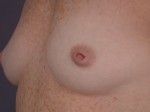 Nipple - Inversion Correction Before and after photo