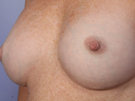 Nipple - Inversion Correction before and after photo