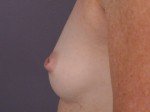 Nipple - Inversion Correction Before and after photo