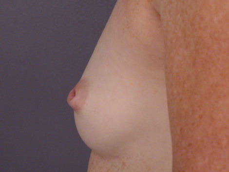 Nipple - Inversion Correction before and after photo