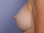 Nipple - Inversion Correction Before and after photo