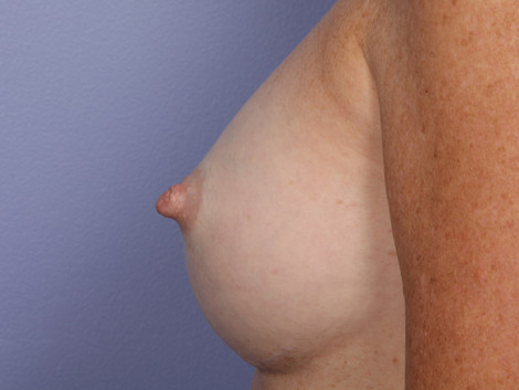 Nipple - Inversion Correction before and after photo