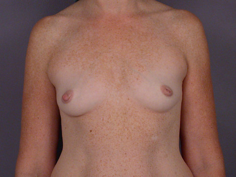 Nipple - Inversion Correction before and after photo