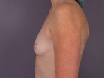 Nipple - Inversion Correction Before and after photo