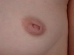 Nipple - Inversion Correction Before and after photo