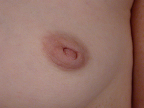 Nipple - Inversion Correction before and after photo