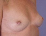 Nipple - Inversion Correction Before and after photo