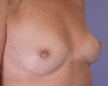 Nipple - Inversion Correction before and after photo