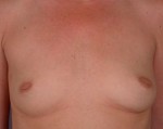 Nipple - Inversion Correction Before and after photo