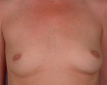 Nipple - Inversion Correction before and after photo