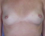 Nipple - Inversion Correction Before and after photo