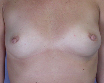 Nipple - Inversion Correction before and after photo