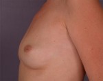 Nipple - Inversion Correction Before and after photo